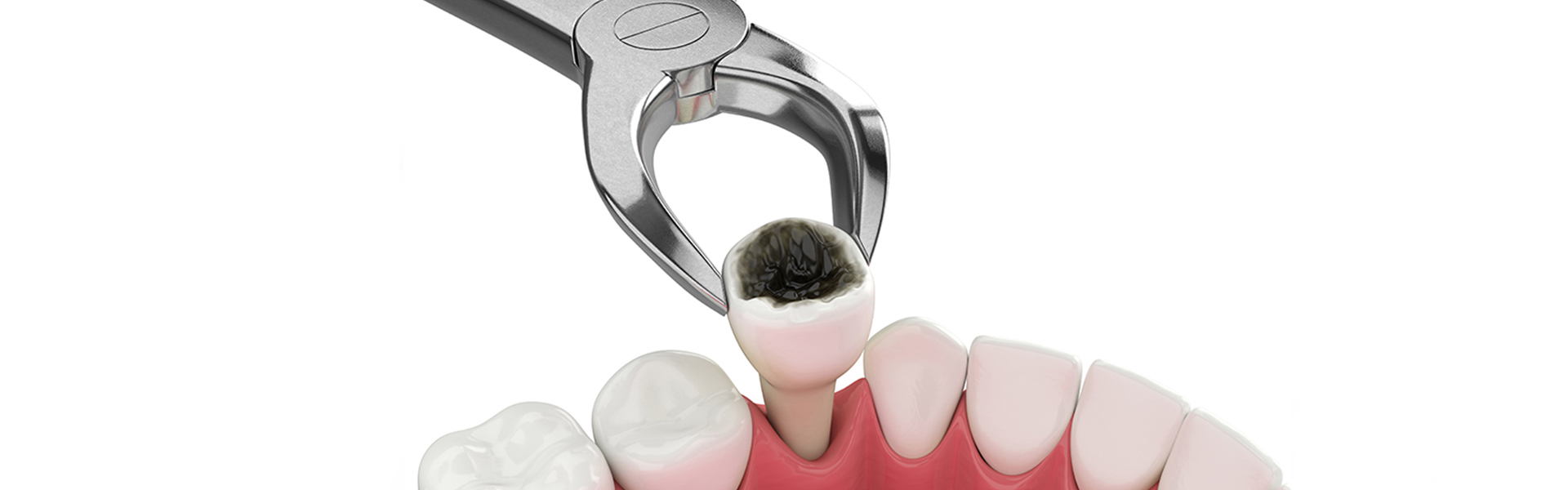 How to Get Rid of a Small Black Spot on Your Molar