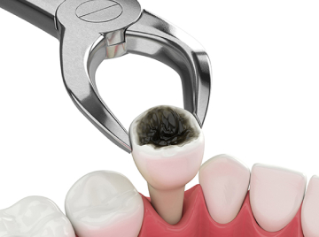 How to Get Rid of a Small Black Spot on Your Molar