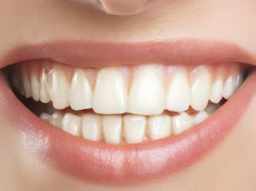 Is Sudden Teeth Discoloration Normal? Causes and Treatments